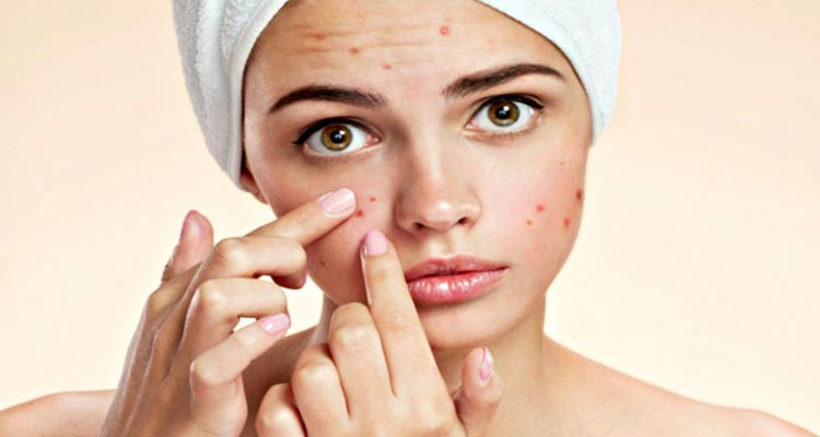 Easy ways to get rid of acne