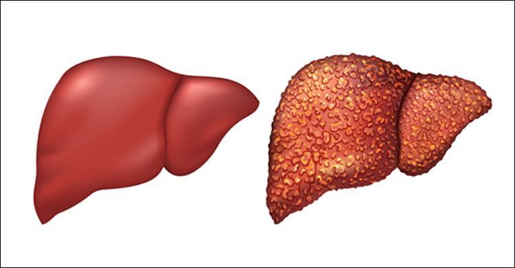 ways-to-get-rid-of-liver-cirrhosis